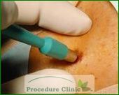 Punch Biopsy